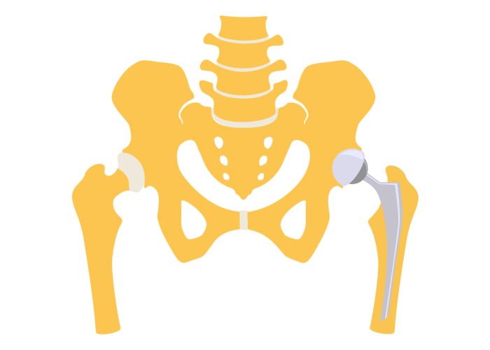 Total hip replacement. Vector illustration.
